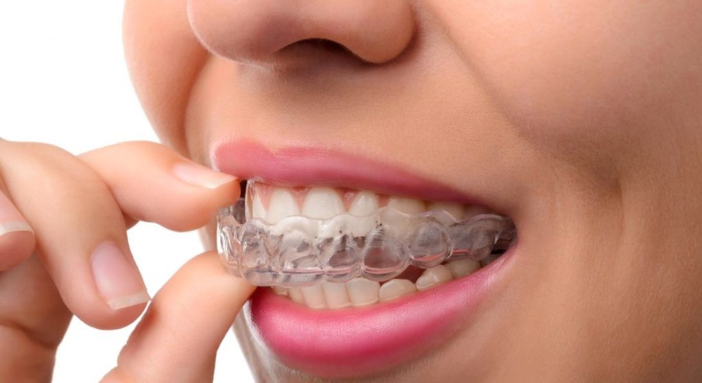 Teeth Straightening: What Are The Options You Get When You Opt For It