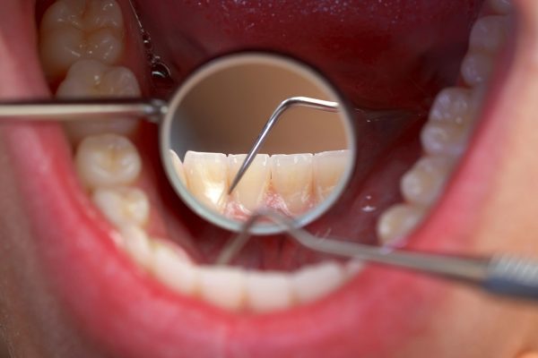 Tooth Erosion