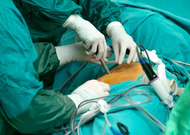 Minimally Invasive Techniques in Spinal Cord Injury Surgery: Reducing Trauma, Accelerating Recovery