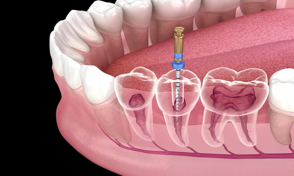 Cracked Teeth Explained: Hidden Damage That Can Threaten Your Oral Health Without Warning